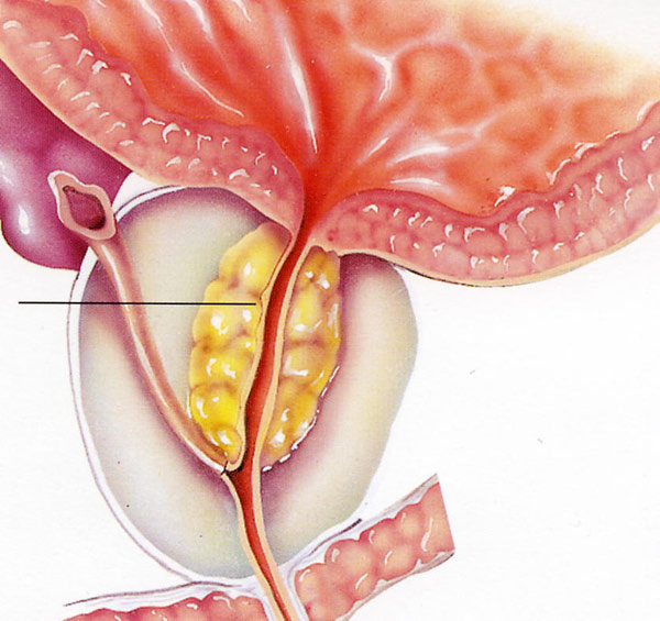 Urethritis a prosztatagyulladás hátterében